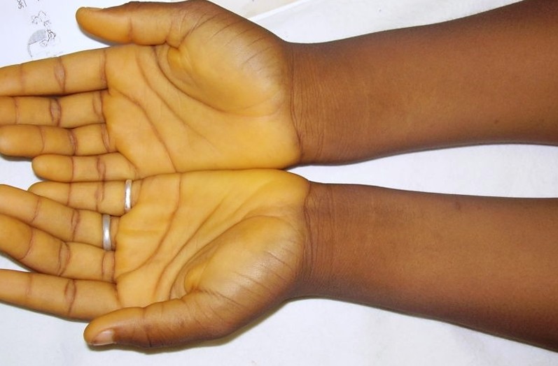 如果是黄疸引起的皮肤粘膜黄染,它首先出现在巩膜,硬腭后部以及软腭