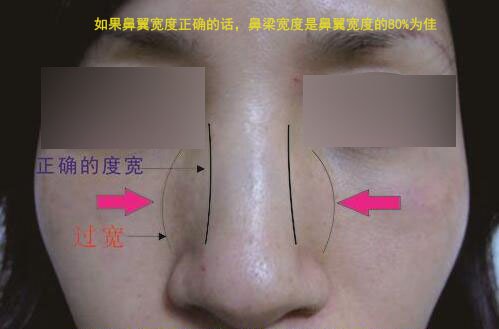 侧面挺翘正面塌的“塌鼻子”你知道是怎么回事吗?_宫风勇_副主任医师_爱问健康