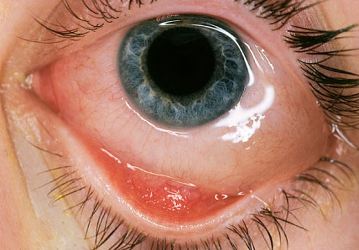 水肿的最主要症状,少数较严重的患者会有眼部烧灼感,重影,眼球转动