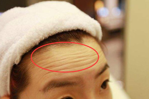 造成抬头纹,鱼尾纹,法令纹的原因有哪些?