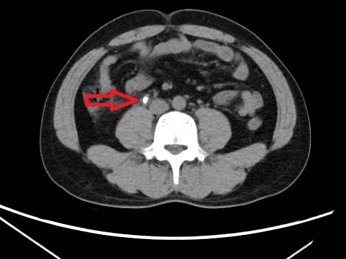 ct提示右侧输尿管上段结石.