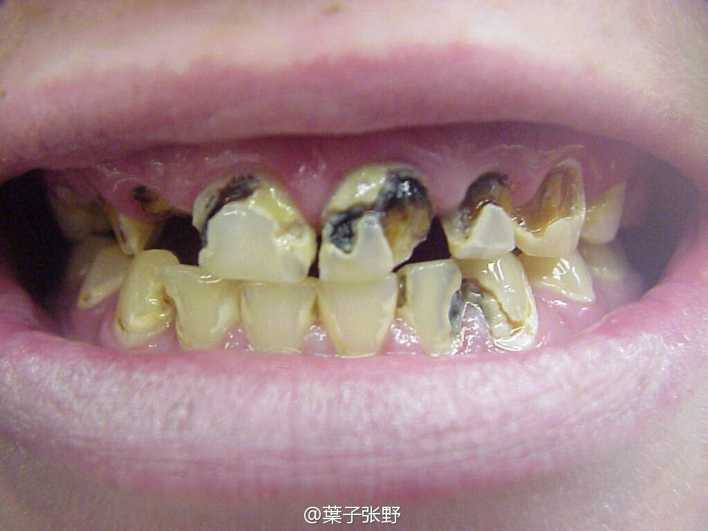 冰毒牙,四环素牙和牙齿色素的区别_爱问健康