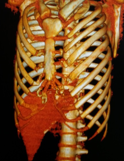 图4,ct提示胸廓形状异常,心脏周围存在黏连