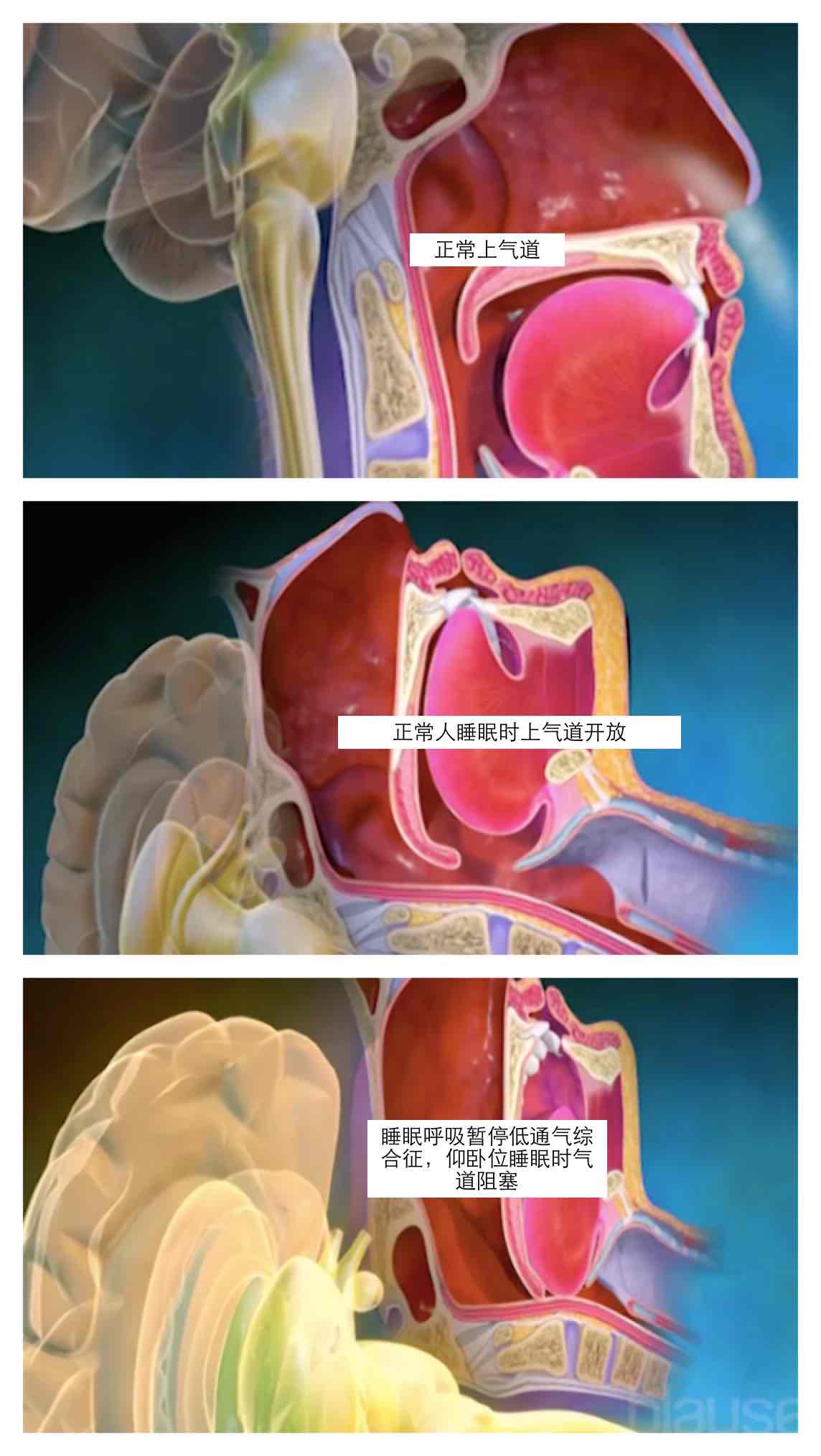 夜间打鼾,白日嗜睡—您需要了解这个病_石娟_主治医师_爱问健康