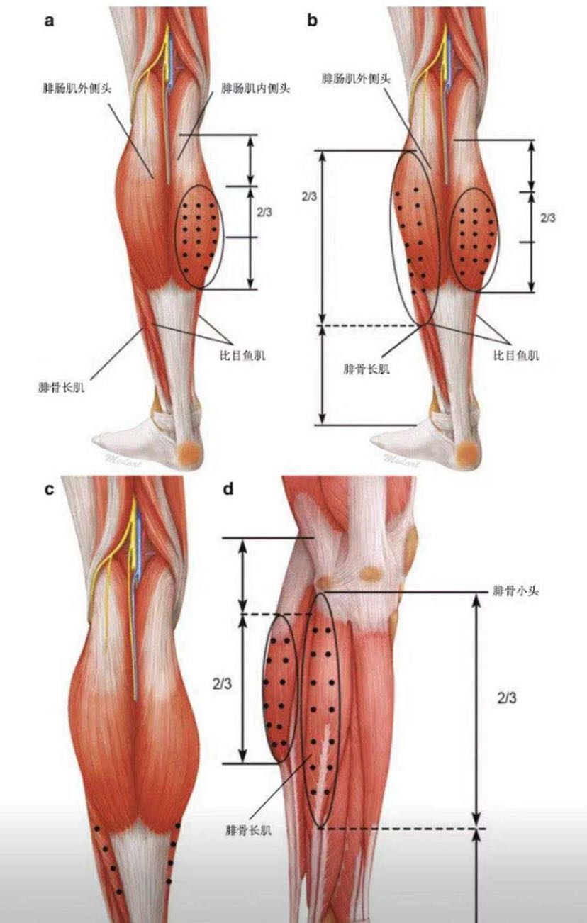 腓肠肌内侧头图片