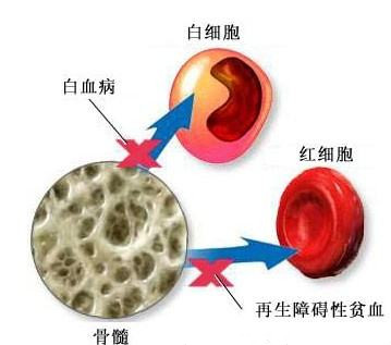 刘风教授谈再生障碍性贫血规范再障治疗赢得生命未来