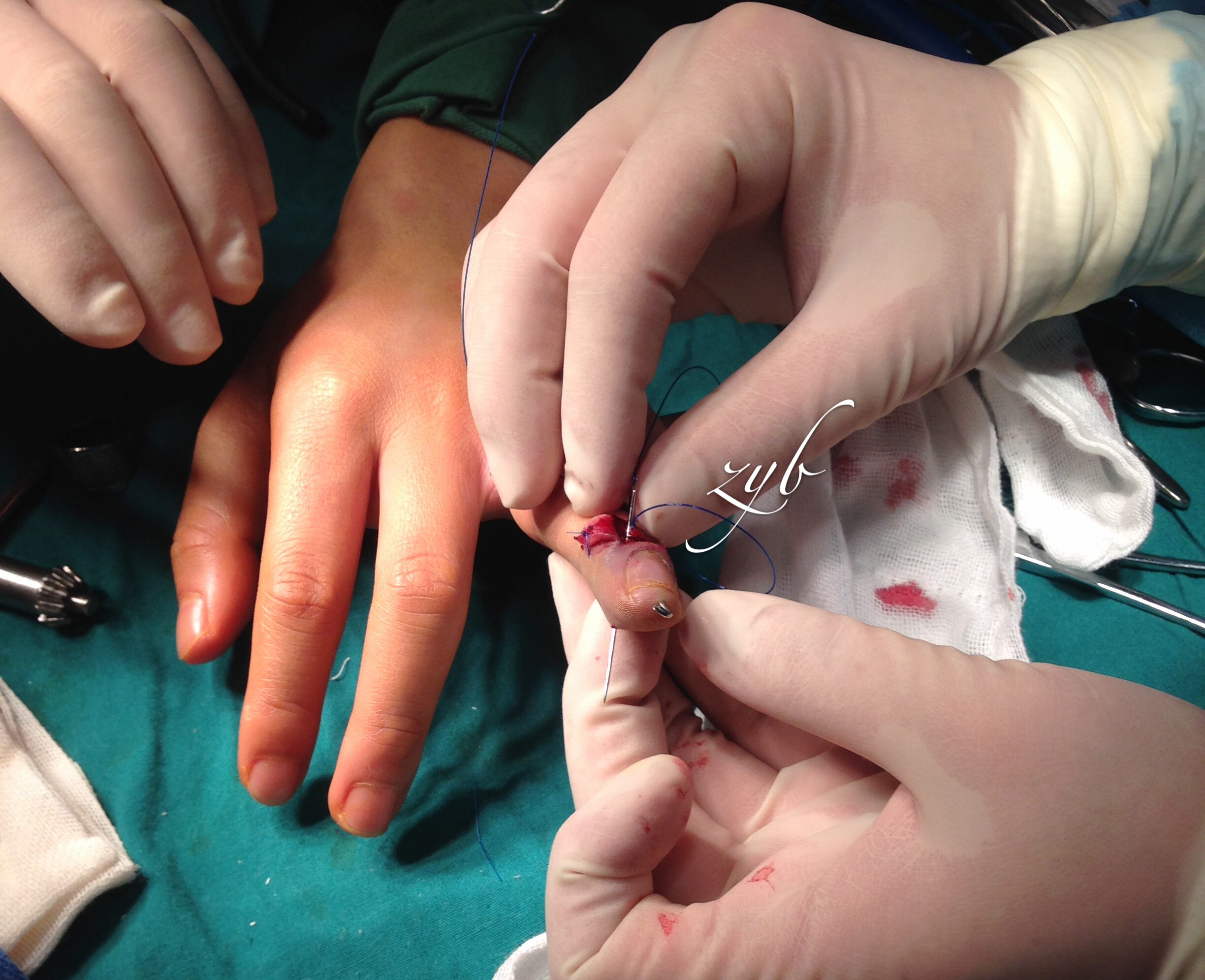 骨性锤状指的经典手术治疗!_郑元波_副主任医师_爱问健康