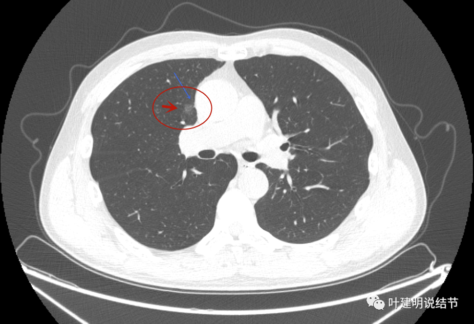 磨玻璃结节是肺癌的前兆?如何预防和治疗?
