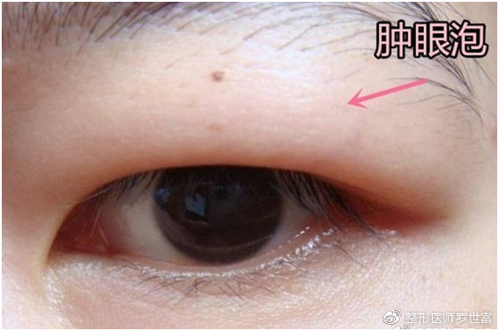 有一种肿泡眼叫做泪腺脱垂