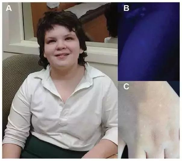 脆性x染色体综合征