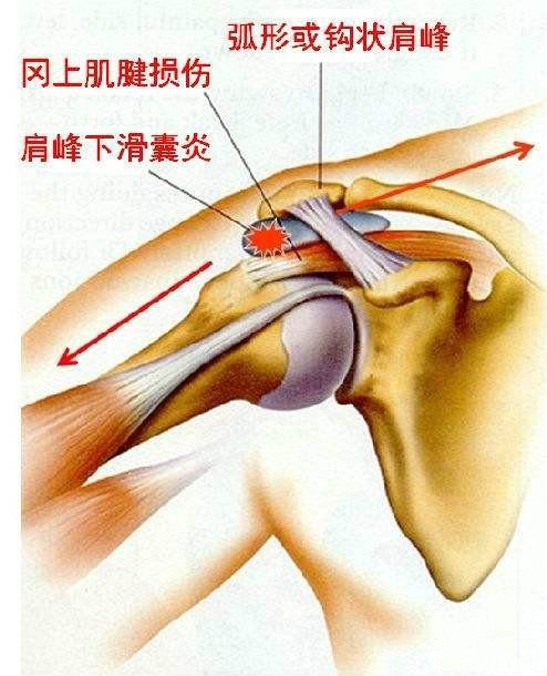 肩峰下滑囊积液图片