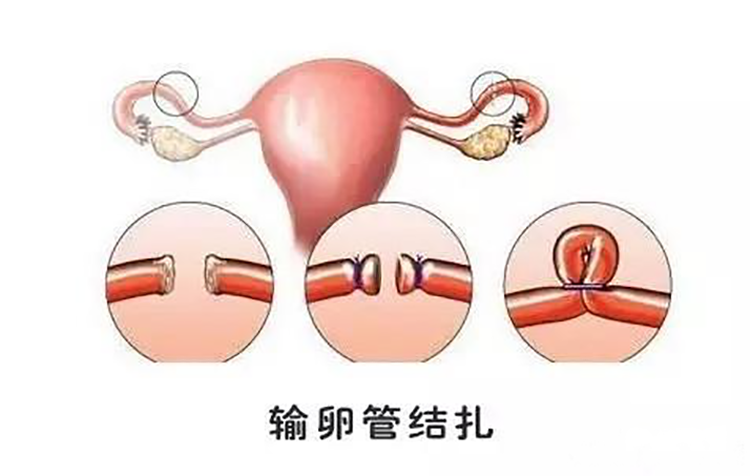 女性结扎 开腹 输卵管图片