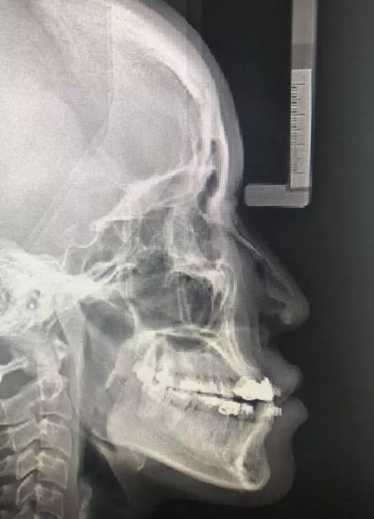 从一台双鄂手术案例谈起,地包天性长脸的face off(变脸_朴兴植_住院