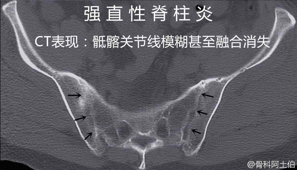 强直性脊柱炎