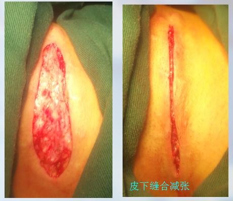 皮下缝合用什么线常用的疤痕切除术切口减张技术_https://www.jmylbn.com_新闻资讯_第1张