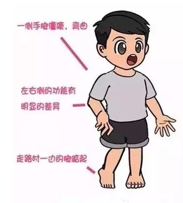 痉挛型偏瘫(spastic hemiplegia)痉挛型双瘫(spastic diplegia)痉挛型