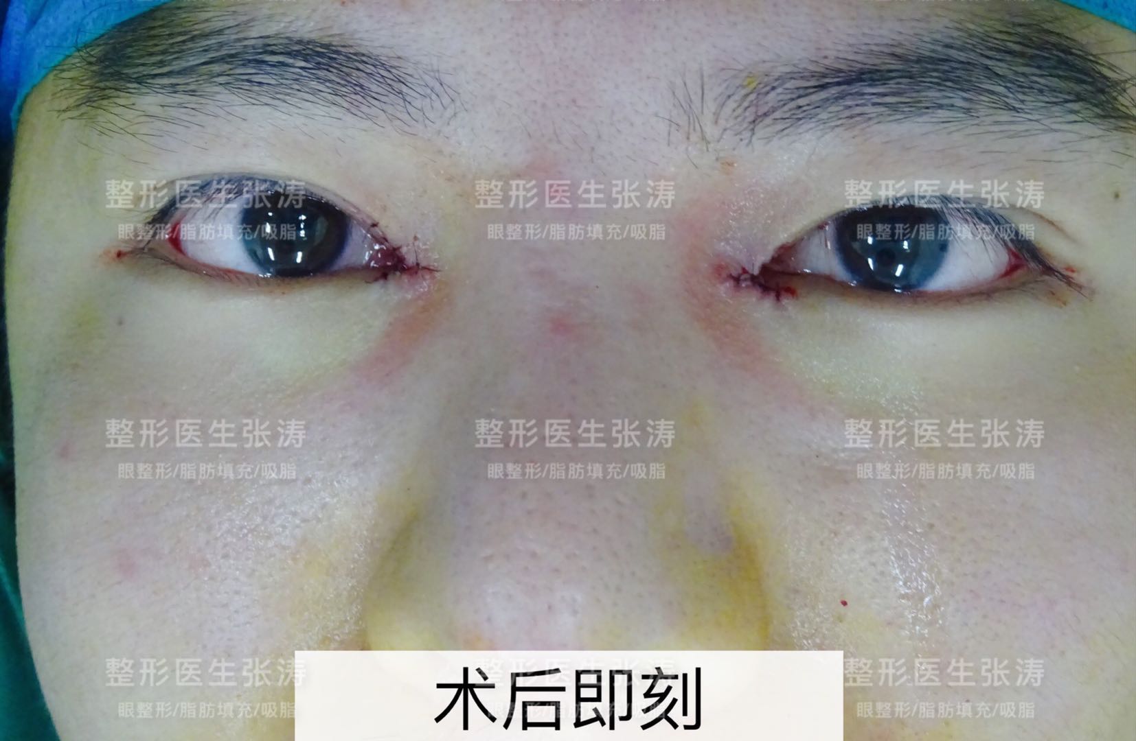 内眦回缩修复——重塑自然桃花眼_张涛__爱问健康