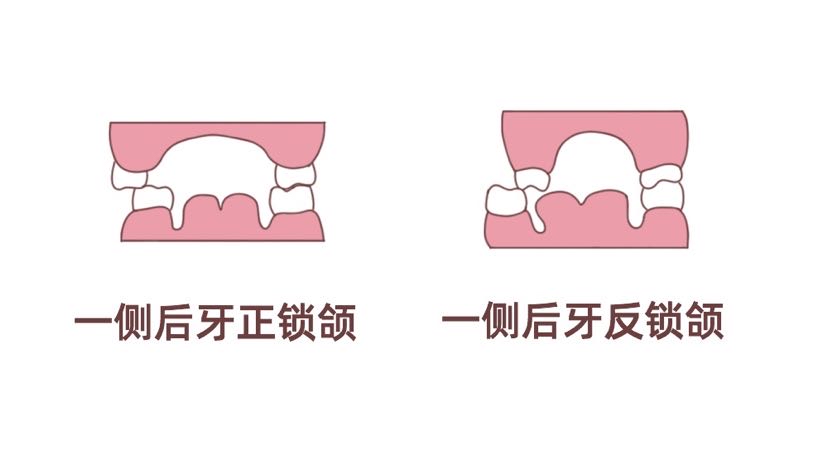 锁颌不及时矫正,会怎样?_张菊菊_主治医师_爱问健康