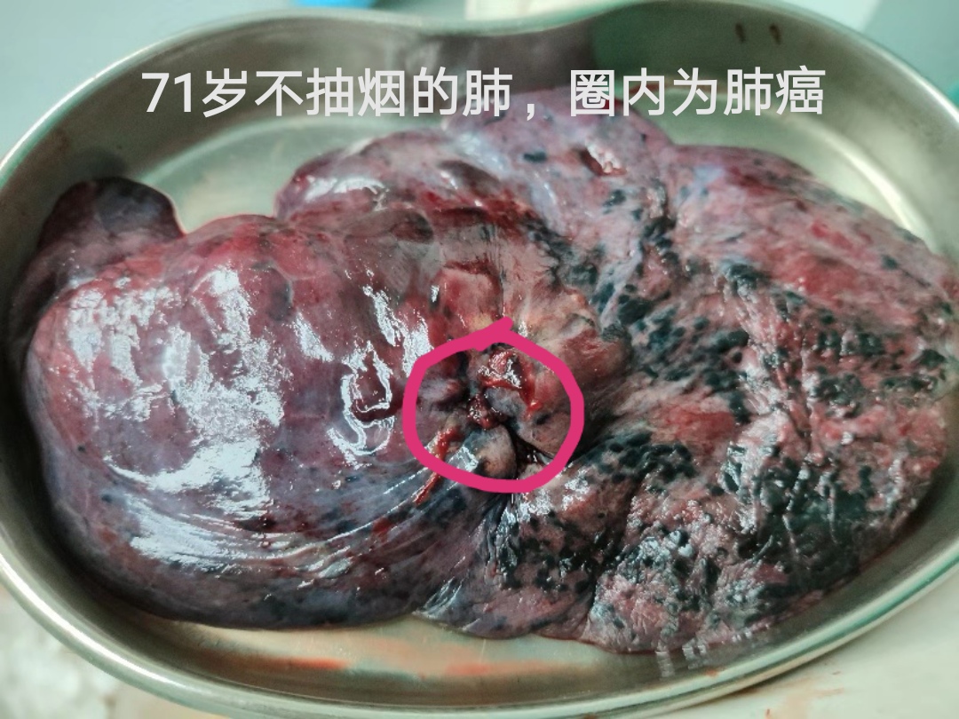 不抽烟的肺是什么样子?