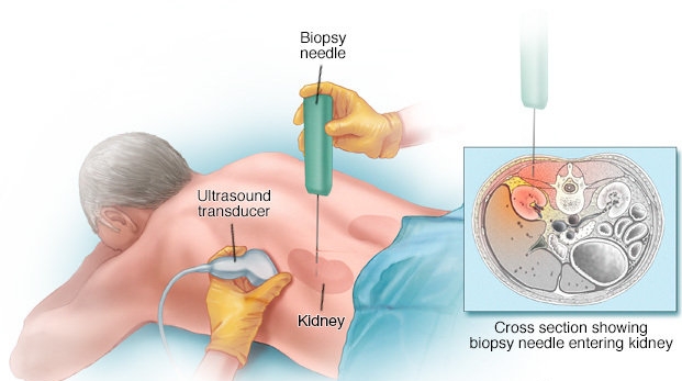 肾穿刺病理活检术科普
