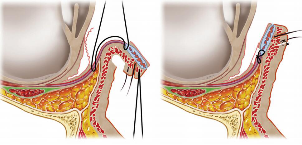 如图所示:手术时在下睑中外侧将睑板下缘与下睑缩肌固定缝合,达到将下