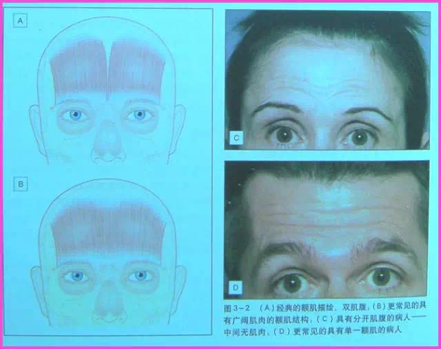 肖丹一根扁弧刃针-面部紧致提拉美容术_肖丹_副主任医师_爱问健康
