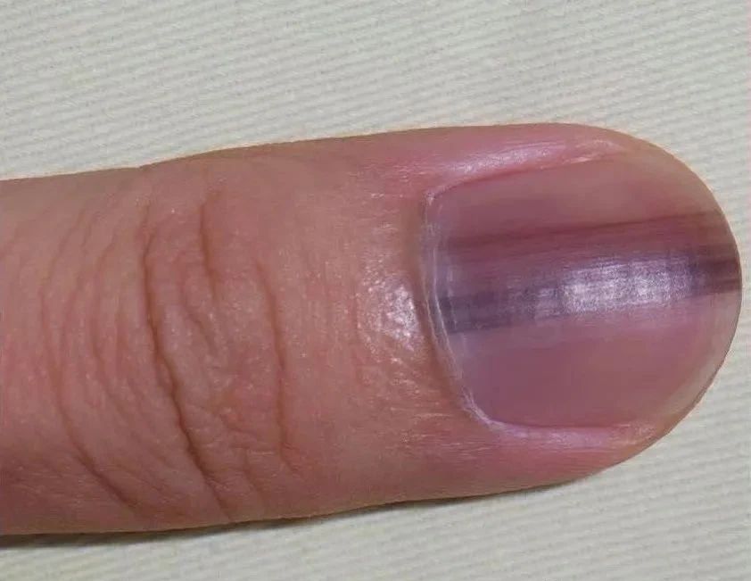 手指甲冒诡异黑线…他拖了5年!竟罹患癌症