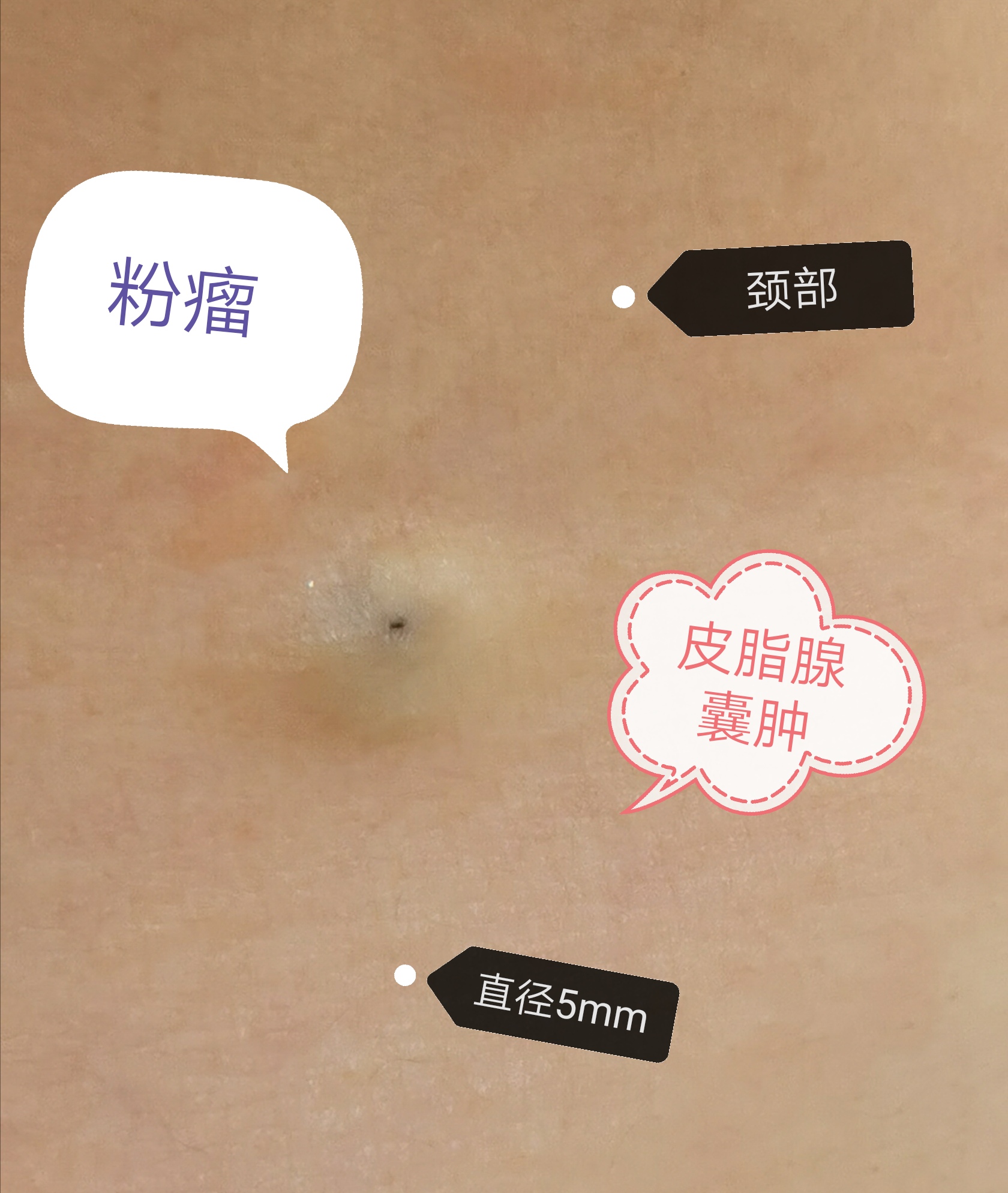 你身上长过这种粉瘤吗?