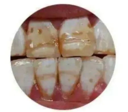氟斑牙和脱矿怎么区分图片