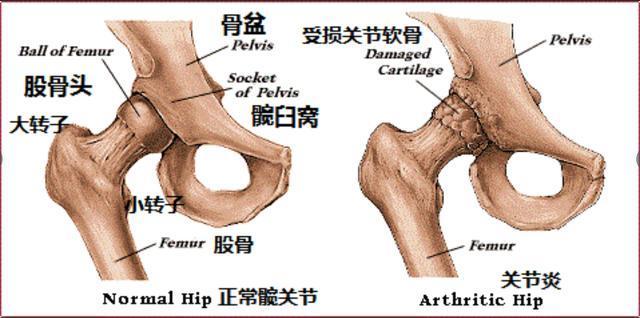 具体到弹响髋这一类疾病,有必要说说髋关节及大腿骨(股骨)周围骨头