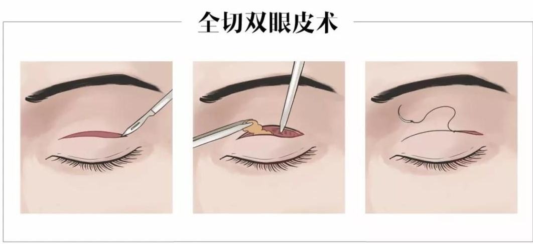 全切双眼皮.jpg