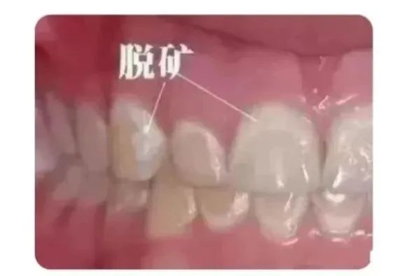 牙齿脱矿 VS 氟斑牙,一分钟带你分清!_周杰__爱问健康