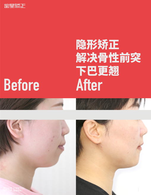 “牙齿锁颌”是什么情况?有影响吗?_季惠__爱问健康