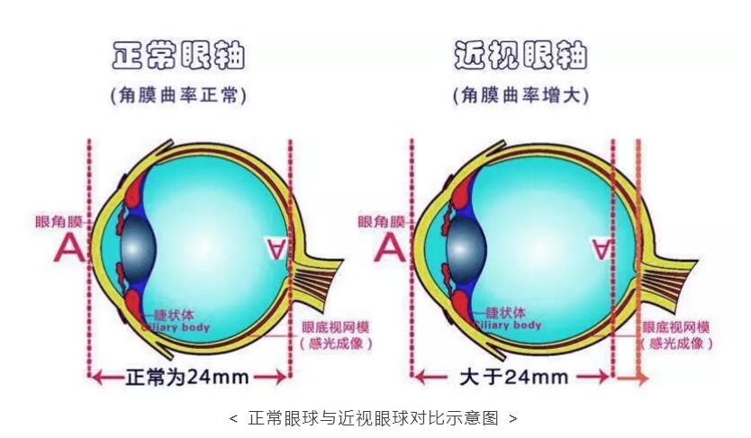 近视眼与正常眼睛外观图片