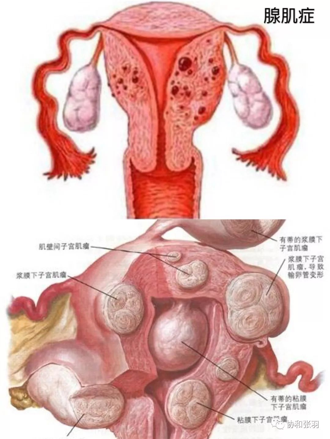 磁波治疗试管婴儿失败的子宫腺肌症后双胎妊娠足月分娩一例