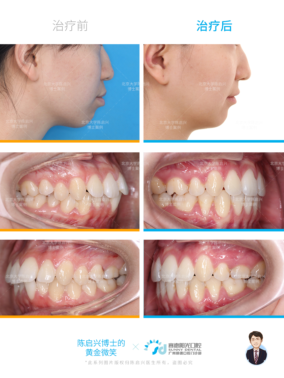 牙齿-侧面及口内对比.jpg