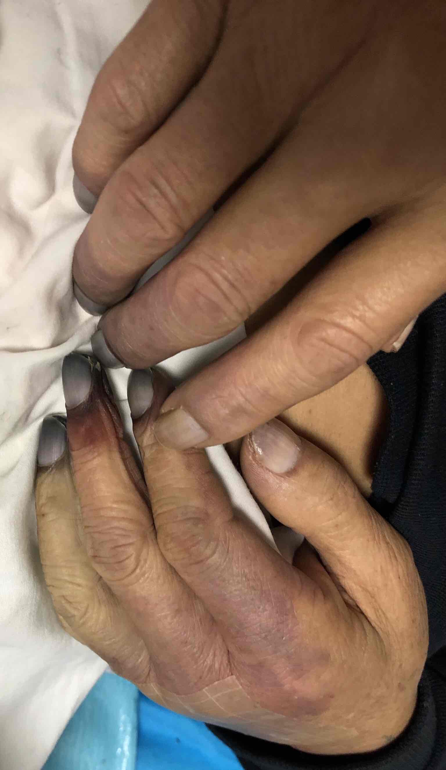 尿毒症严重并发症-钙化防御_邓洪__爱问健康