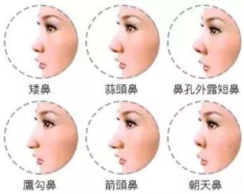 想要整鼻子的你,请收下这份“鼻”修课!_朱晓波_住院医师_爱问健康