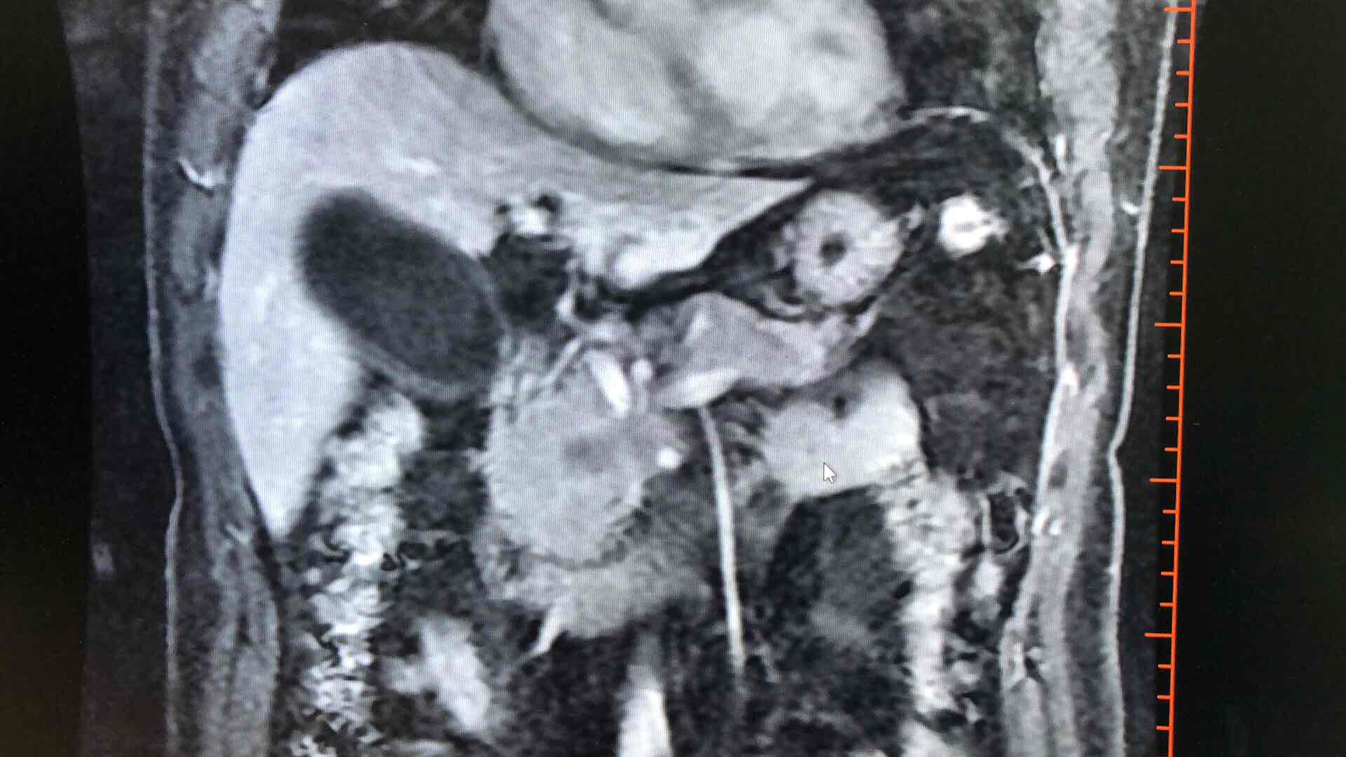 胰腺癌做CT好还是做磁共振好?_梁宗辉_主任医师_爱问健康