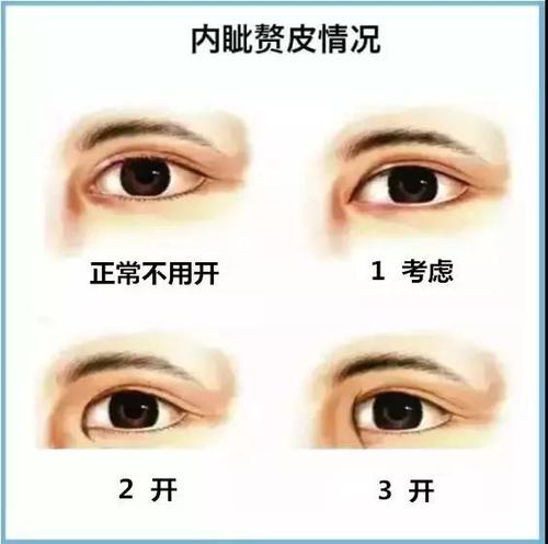 解读内眦赘皮|影响眼部形态的内眦赘皮,内眦赘皮一定要开?_高亮__爱问健康