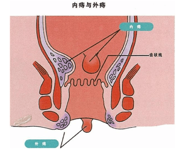 轻微痔疮轻度图片