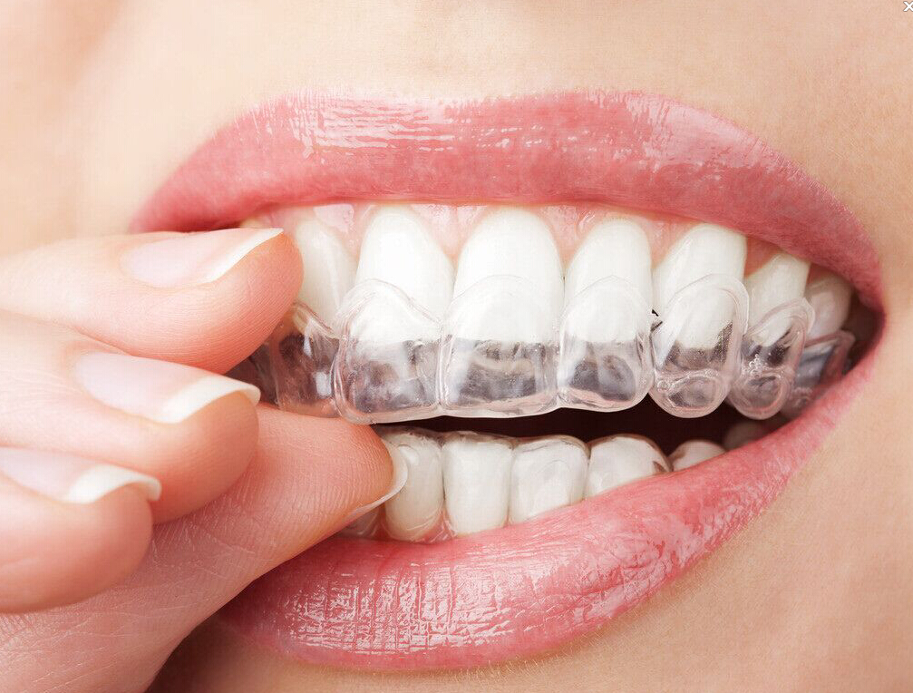 你所不知道的正畸知识点给你全"配齐"!