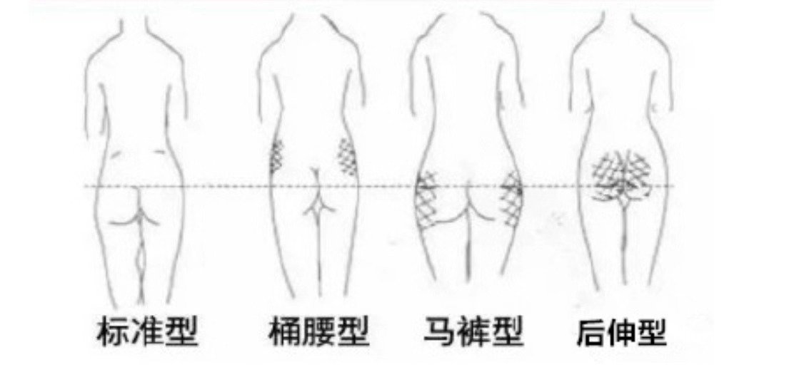按照臀部脂肪的堆积情况，可以将臀部分为四种类型