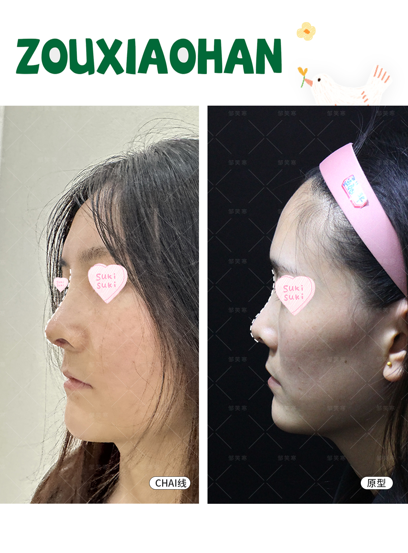 如何拯救塌鼻子_邹笑寒_副主任医师_爱问健康