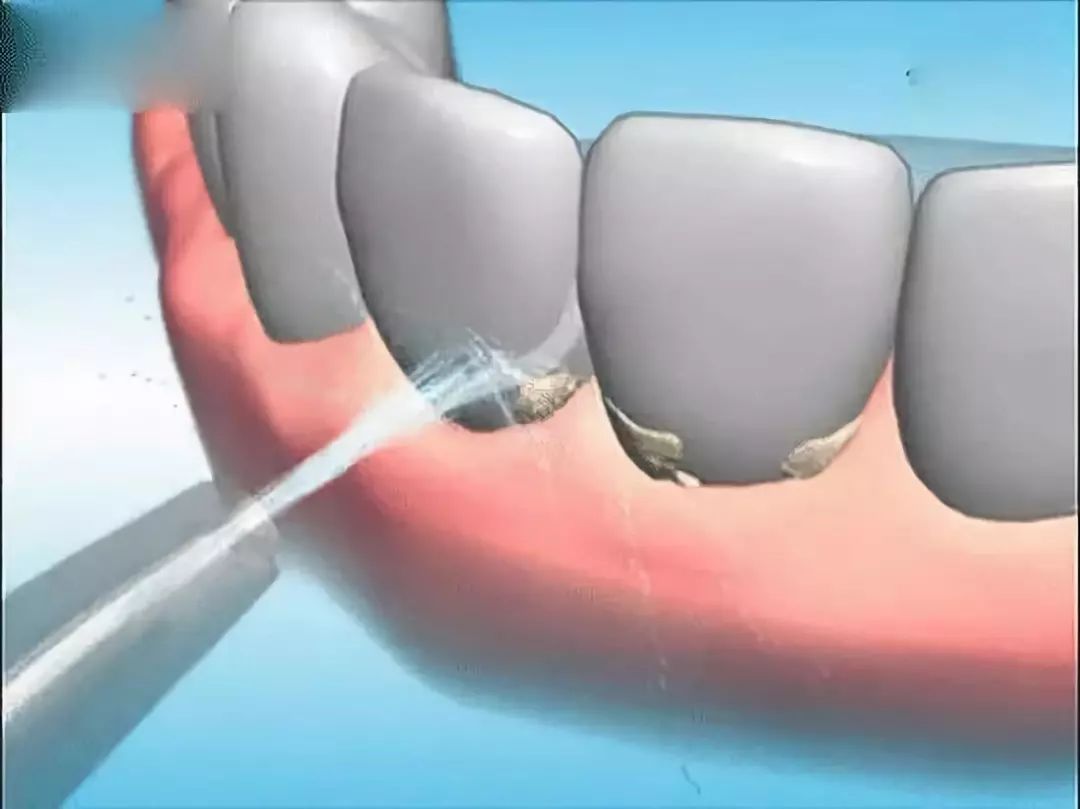 洗牙又叫龈上洁治术是指用洁治器械去掉牙石,菌斑和牙面上沉积的