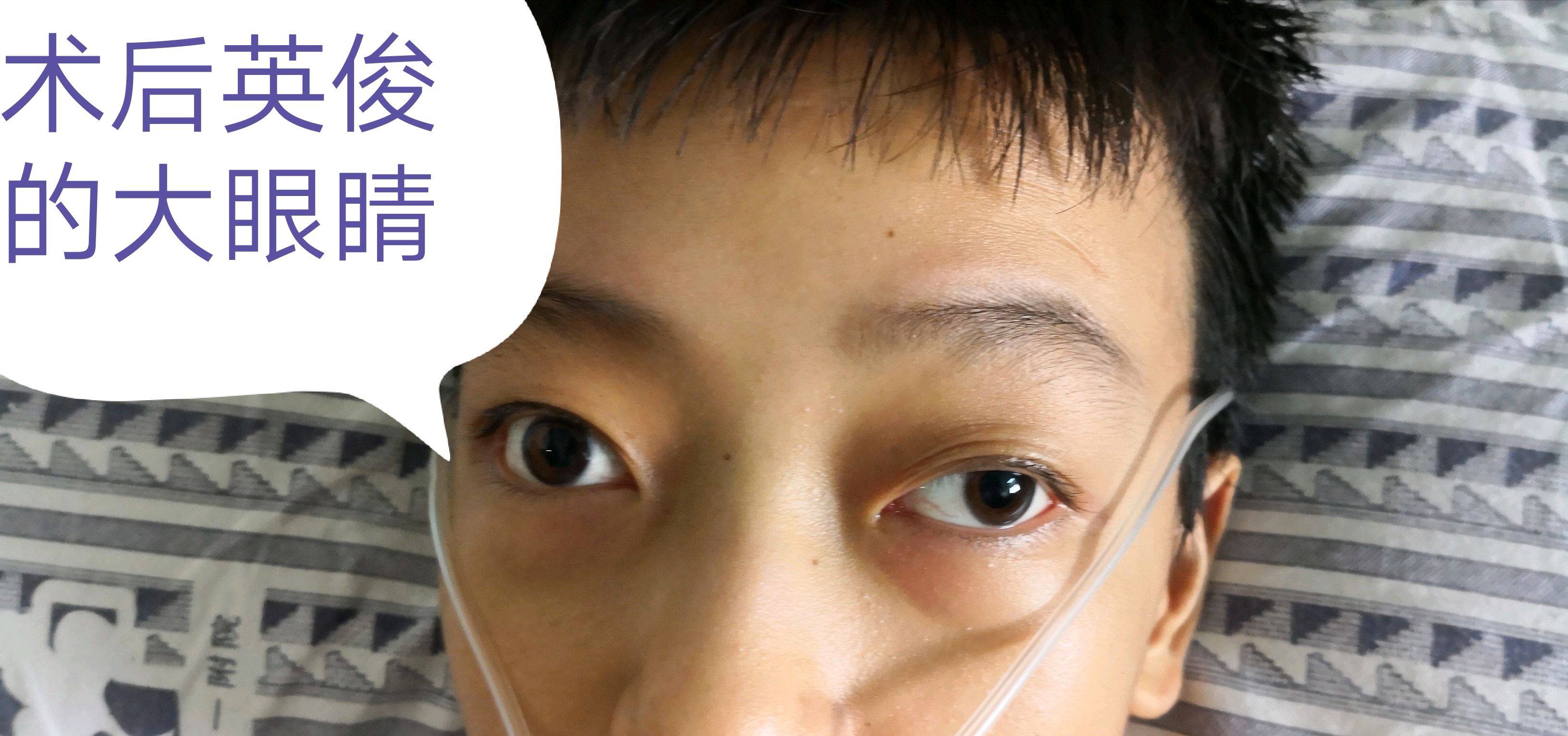 重症肌无力做手术有用吗?看看微创手术前后对比!