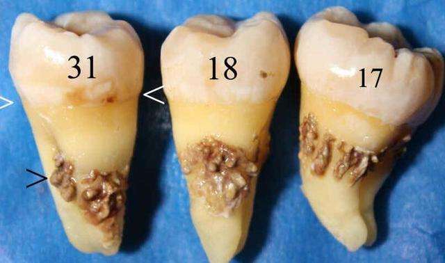 你的牙医告诉过你,你的一口老牙,其实都是牙结石撑起来的