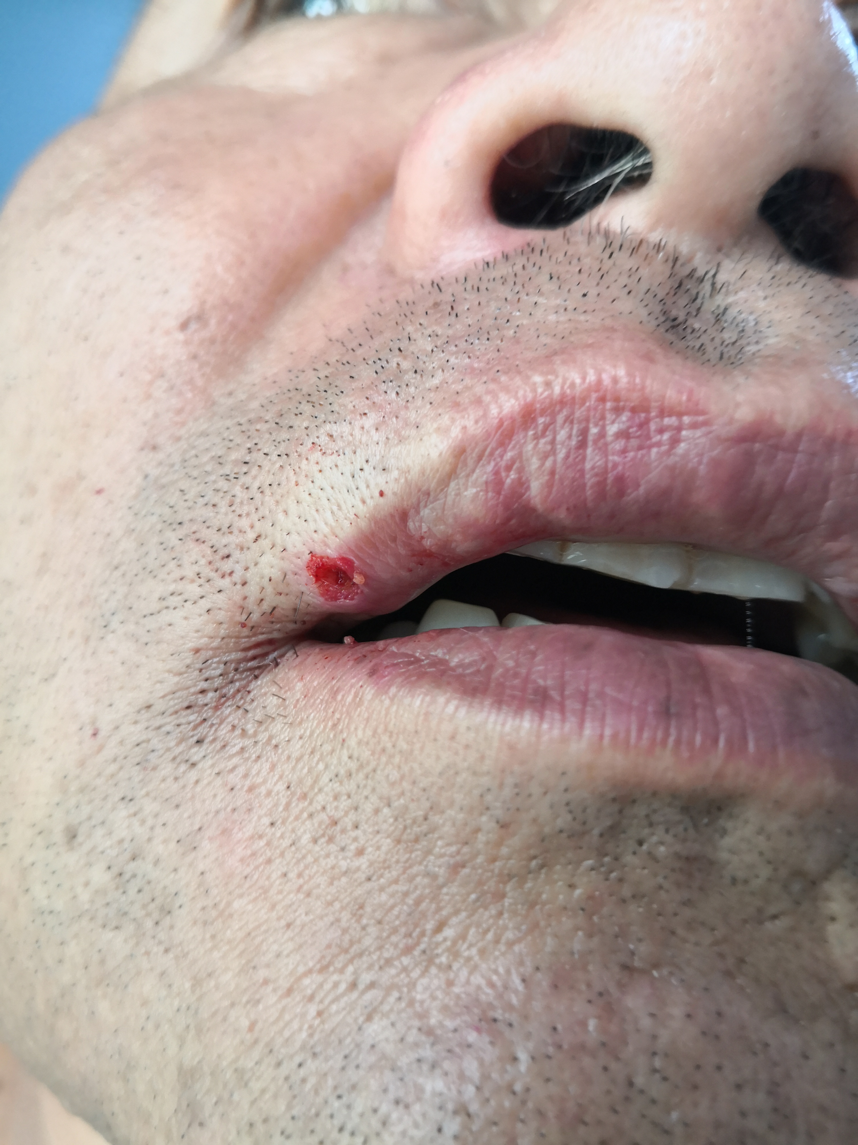 这种疾病是化脓性肉芽肿的症状.