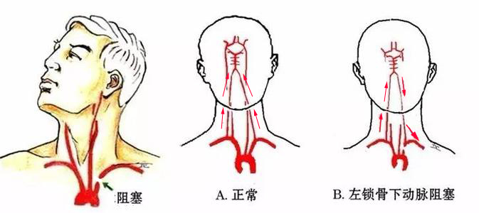 锁骨下动脉闭塞如何治疗?