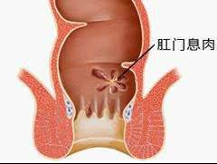 肛门息肉不痛不痒,需要治疗吗